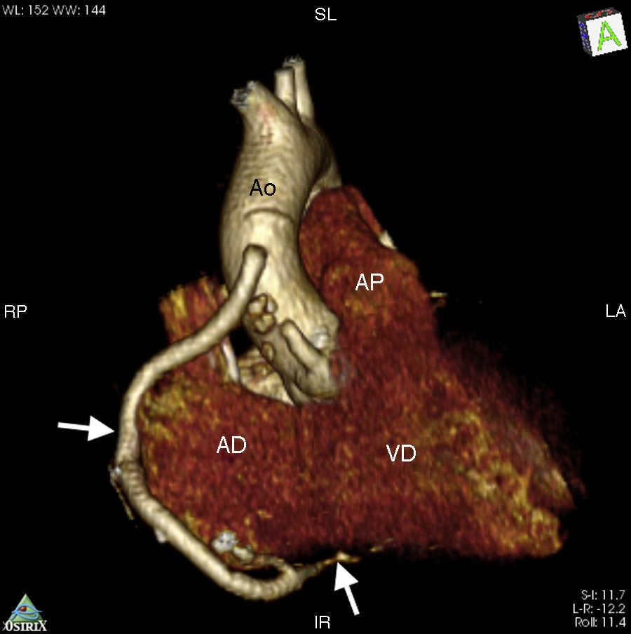 
					Tomografía cardiaca: reconstrucción volumétrica, se visualiza el hemoducto el cual emerge de la aorta ascendente y se conecta con la porción distal de la coronaria derecha.
				