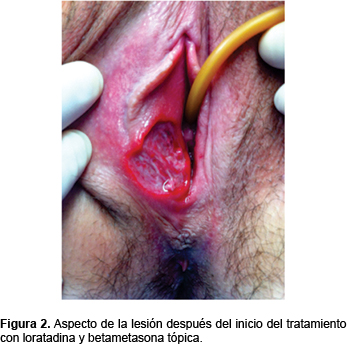 Lipschütz ulcers: uncommon diagnosis of vulvar ulcerations ...