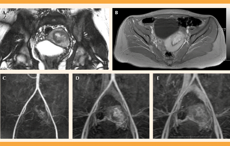 Malformación Arteriovenosa Uterina Congénita Presentación De Un Caso 