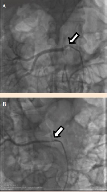 pin binde Cornwall Estenosis bilateral de arteria renal por displasia fibromuscular