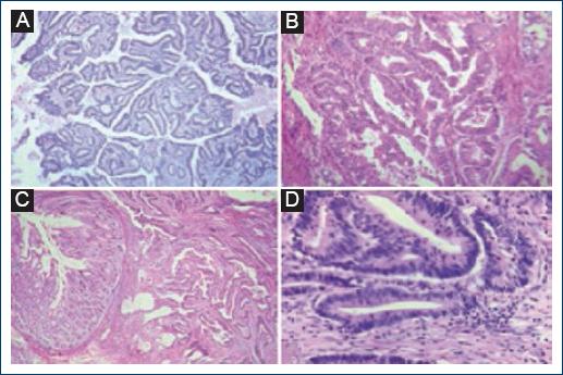
                    Histological sections stained with hematoxylin-eosin were observed in
                        four of the 23 cases studied. A-D: The morphological
                        characteristics of moderately differentiated adenocarcinomas are
                        demonstrated; histologic grade most frequently identified.
                