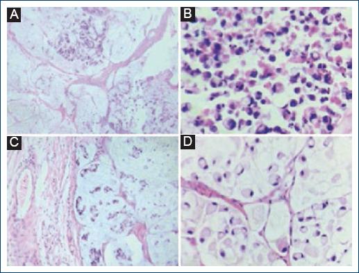 
                    A-D: Histological sections stained with hematoxylin-eosin
                        were observed in two cases with mucinous differentiation and the presence of
                        signet ring cells. A-B: Areas with mucinous material are
                        observed. C-D: At higher magnification, signet ring cells
                        immersed in the mucinous material are identified.
                