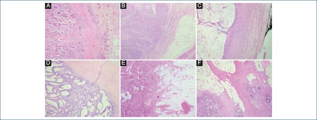 
                    Histological sections stained with hematoxylin-eosin were observed in six
                        cases. A-D: Correspond to lesions that show border with a
                        pushing pattern. E-F: Infiltrating growth pattern.
                