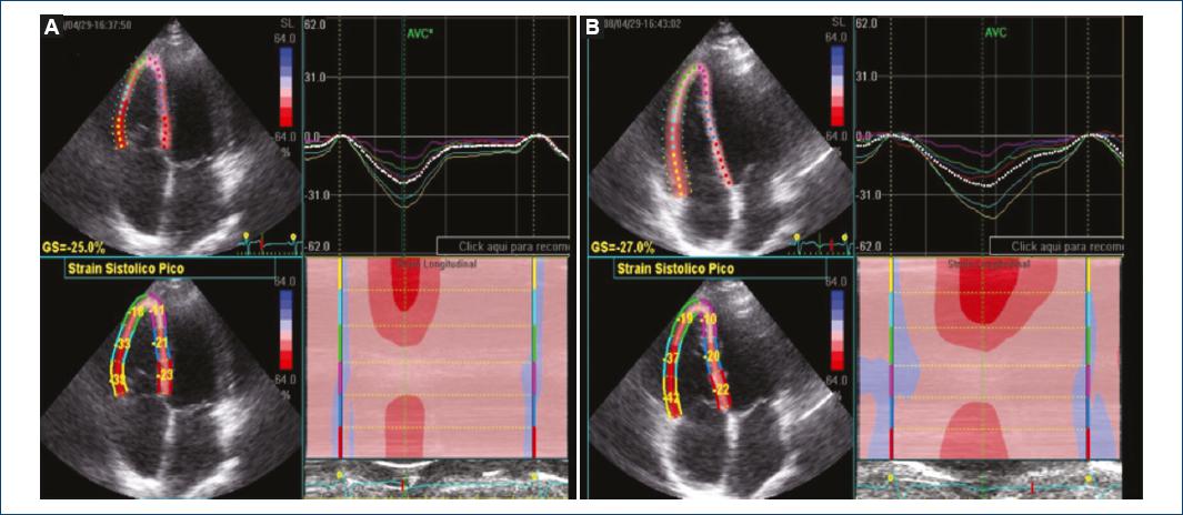 Global longitudinal strain by speckle tracking echocardiography.