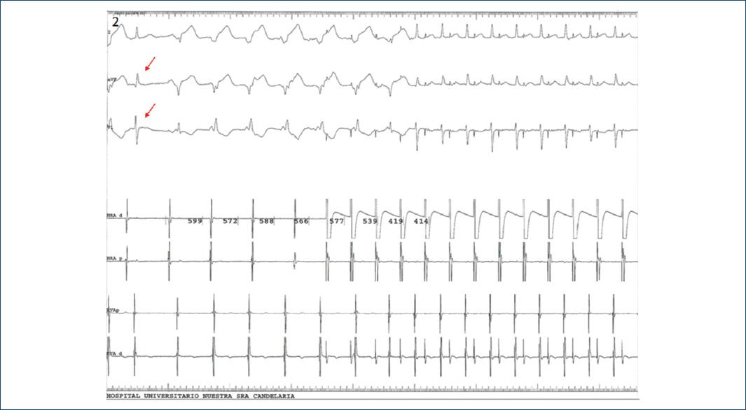 Ritmo Riva Ritmo idioventricular asociado a cuadro vagal