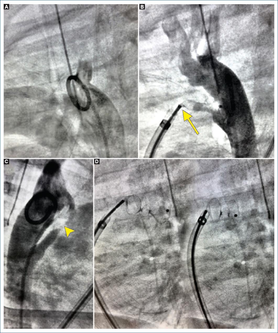 Krichenko Classification Ductal spasm versus angiographic variations during patent ductus ...