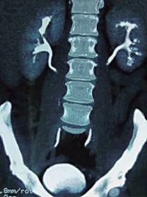Hallazgos tomográficos característicos de tuberculosis renal bilateral