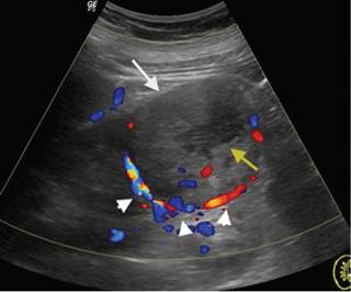 Diagnóstico por imagen del oncocitoma renal