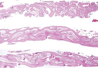 Metaplasia ósea endometrial