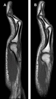 
						A) Resonancia magnética sagital T1 del quinto dedo de la mano derecha y B) mano izquierda. Hiperflexión de la articulación interfalángica proximal, con discreta extensión de la articulación interfalángica distal.
					