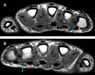 
						Resonancia magnética axial T1 a nivel de la articulación metacarpofalángica, de la mano derecha (A) e izquierda. (B) Inserción aberrante del cuarto músculo lumbrical (flecha azul) hacia el tendón flexor superficial del cuarto dedo (asterisco rojo), con curso más superficial de lo habitual. Disminución en el grosor del vientre muscular del cuarto lumbrical, más evidente en la mano izquierda. Tendón superficial y profundo del quinto dedo (asterisco amarillo).
					