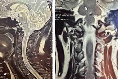 
					Imágenes de resonancia magnética ponderadas en T2, en corte sagital (A) y coronal (B) de columna cervical y parte del cráneo en paciente femenino de 37 años asintomática neurológicamente. Se observa, como hallazgo incidental, lesión de 3 mm en zona inferior central de la protuberancia.
				