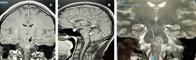 
					Dos años después, imágenes de resonancia magnética de cráneo ponderadas en T1 en cortes corona y sagital respectivamente (A y B) y, ponderada en T2 en corte coronal (C). Se muestra imagen en “palomita de maíz” (popcorn en idioma inglés), rodeada de halo difuso indicando edema y hemosiderina por sangrado de cavernoma en parte central de protuberancia.
				