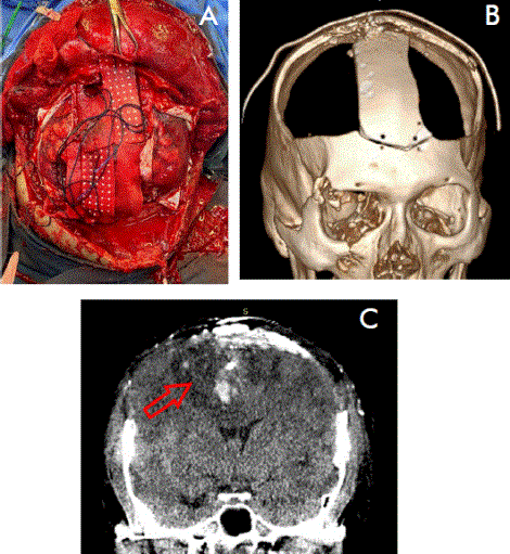 Bilateral decompressive craniectomy in a patient with head injuries ...