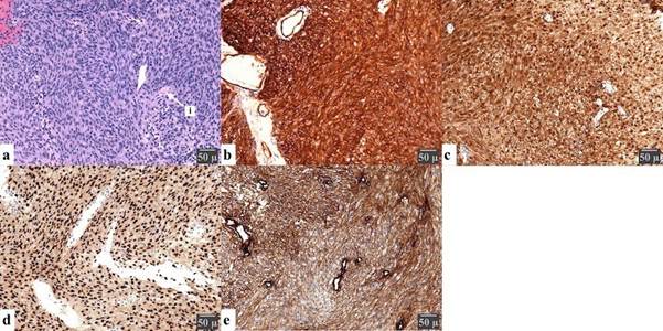 An unusual diffuse CD34 staining in an olfractory groove cellular ...