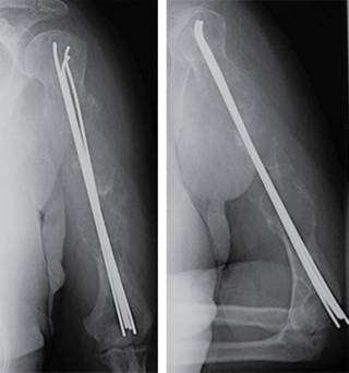 Continuous pain and swelling after humerus fracture in an 86-years-old ...