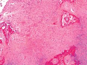 Continuous pain and swelling after humerus fracture in an 86-years-old ...