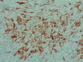 Continuous pain and swelling after humerus fracture in an 86-years-old ...