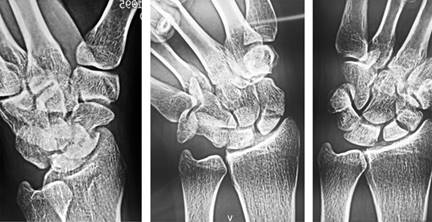 tratamiento-de-no-uni-n-de-fractura-de-escafoides-con-tornillos