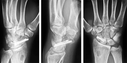 tratamiento-de-no-uni-n-de-fractura-de-escafoides-con-tornillos