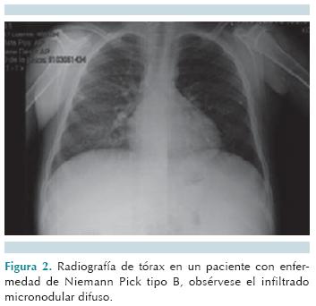 Enfermedad de Niemann-Pick tipo B – FEMEXER