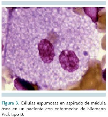 Radiografía de tórax en un paciente con enfermedad de Niemann Pick