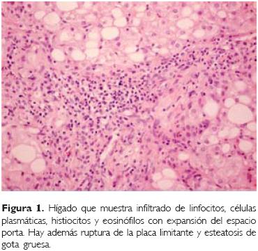 Hepatoesplenomegalia masiva en un paciente con enfermedad de