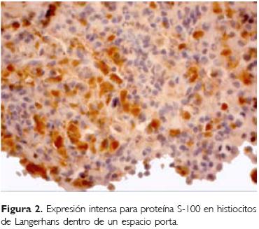 Hepatoesplenomegalia masiva en un paciente con enfermedad de Niemann