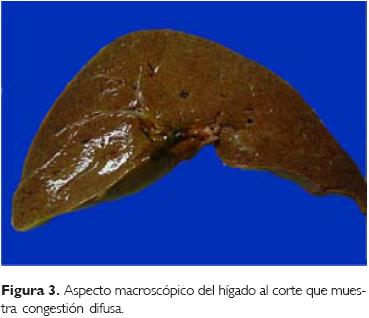 Hepatoesplenomegalia masiva en un paciente con enfermedad de