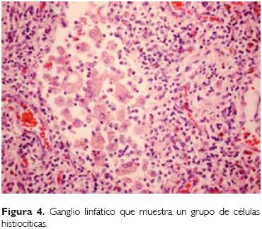 Hepatoesplenomegalia masiva en un paciente con enfermedad de Niemann