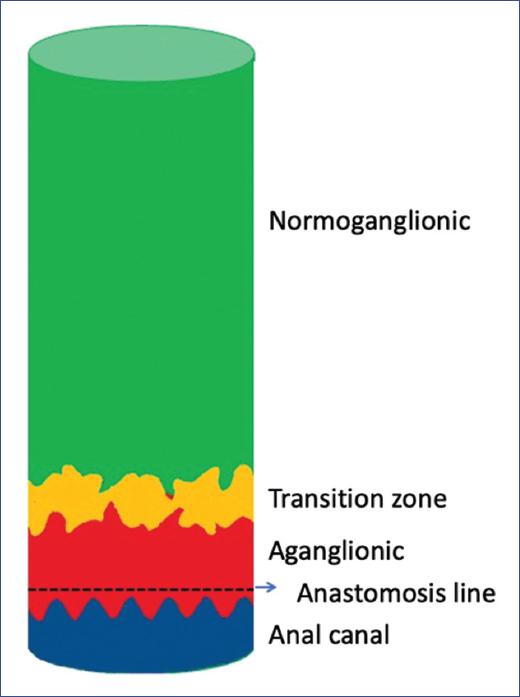 Histological transitional zone pull-through in Hirschsprung disease ...