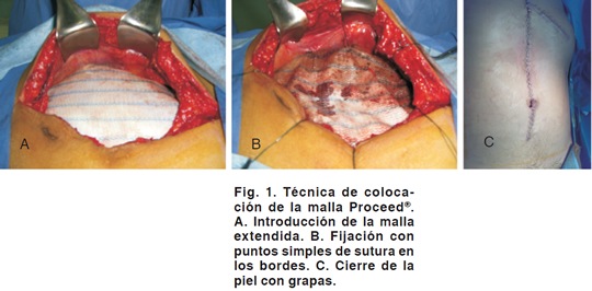 Cirugía de la pared abdominal – Cirugía Balsells