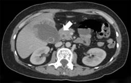 Absceso hepático secundario a ruptura intrahepática de piocolecisto