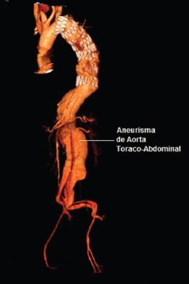Factores que impactan la función renal durante la reconstrucción ...