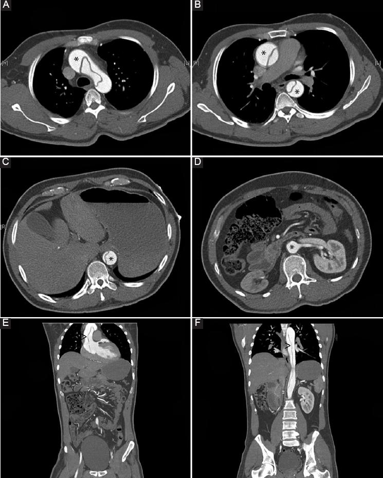 s-ndrome-de-la-arteria-espinal-anterior-y-disecci-n-de-aorta