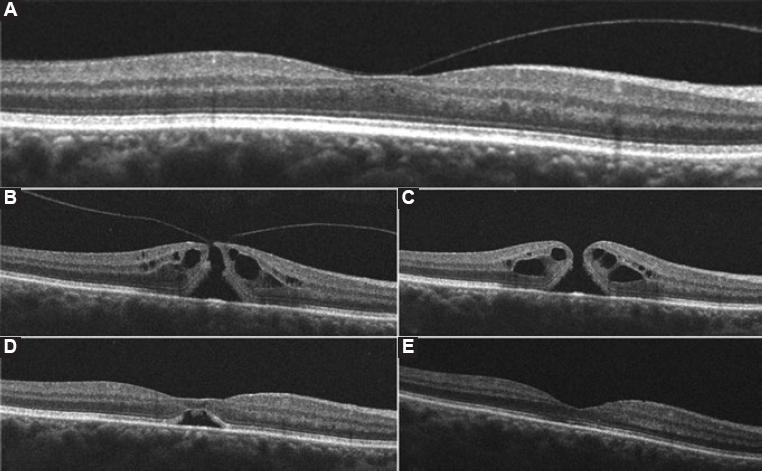 Closure of stage 2 macular hole with a low-dose intravitreal injection ...