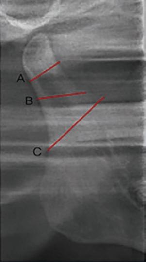 Mandibular condyle fractures: A diagnosis with controversial treatment