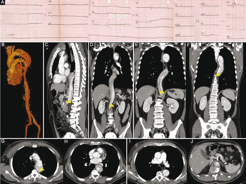 Block Dissection Complete atrioventricular block as an initial manifestation of aortic ...