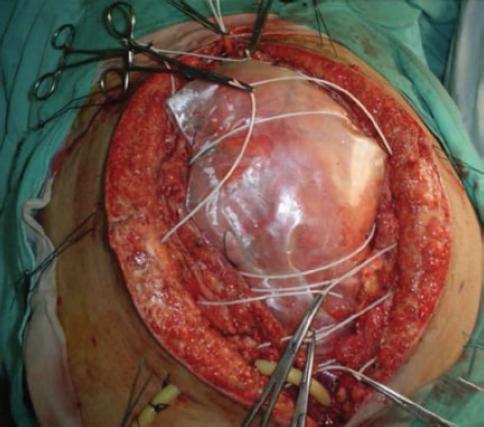 Cierre secuencial de la pared abdominal en el manejo del abdomen abierto.  Una nueva técnica quirúrgica