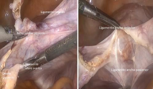 Ooforectomía derecha Video Laparoscopica 