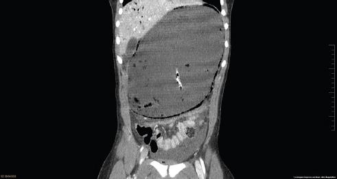 Acute massive gastric distention with emphysematous gastritis: a case ...