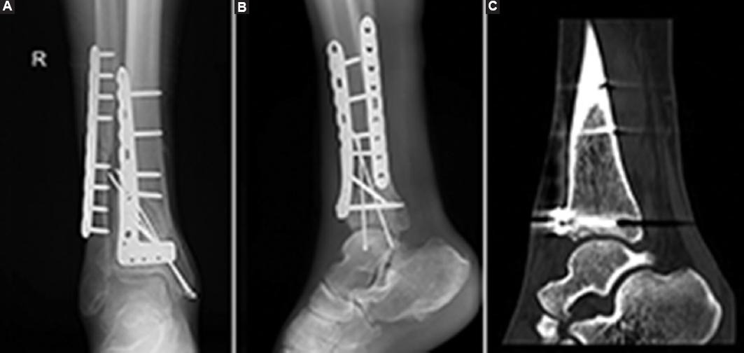 Open Pilon A strategy for the one-stage treatment of open Pilon fractures based on ...
