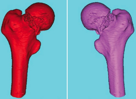Application of MINICS software in measuring parameters of femoral neck ...
