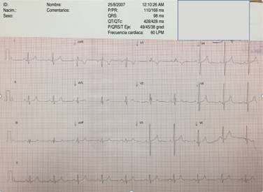 Abnormal origin of the right pulmonary artery from the aorta. Case ...