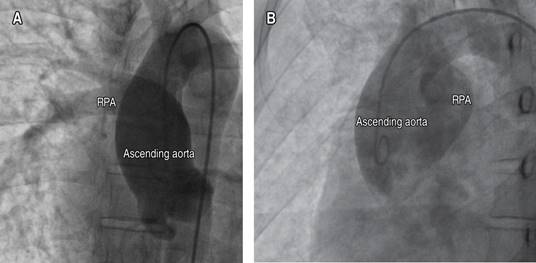 Abnormal origin of the right pulmonary artery from the aorta. Case ...
