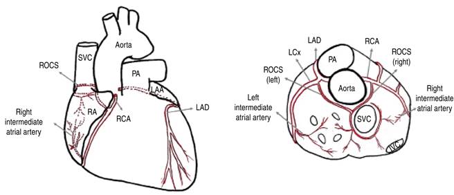 Atrial Infarction Atrial infarction: a literature review