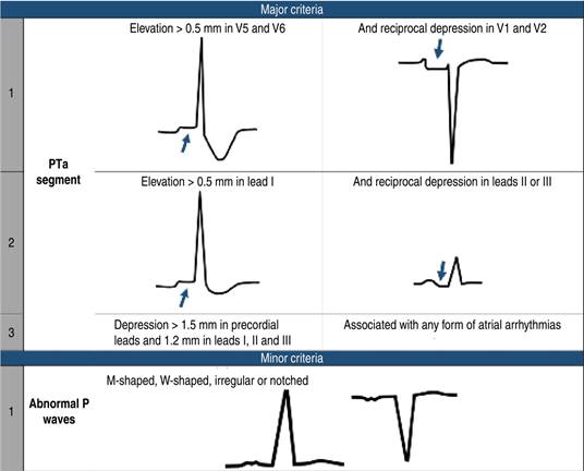 Atrial Infarction Atrial infarction: a literature review