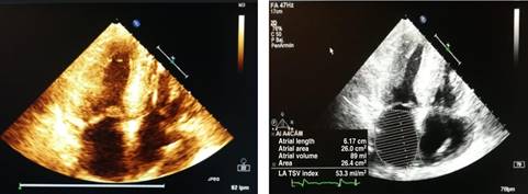 Cardiac amyloidosis with acute heart failure as a clinical presentation