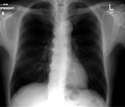 «A boot in a heart». A case report of non-ruptured aneurysm of Valsalva ...