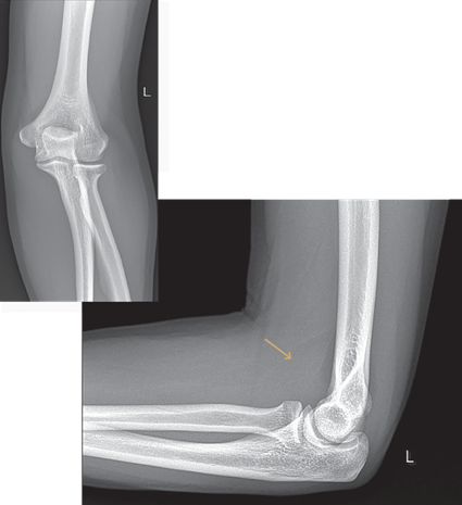 Radiografía Del Codo